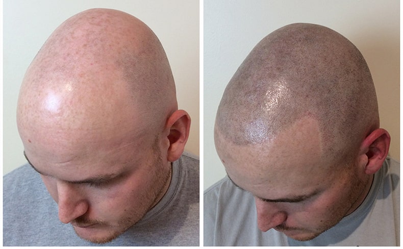 Minimizing-the-Scalp