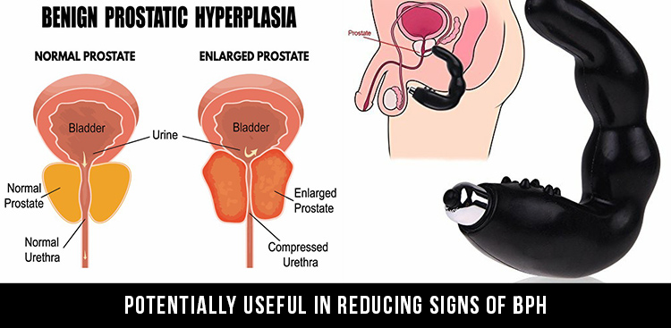 Reducing Signs of BPH prostate orgasm